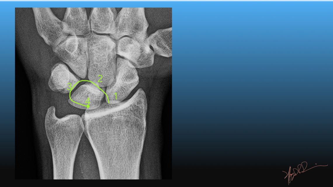 Mayfield Classification Of Wrist Injuries Uw Emergency Radiology